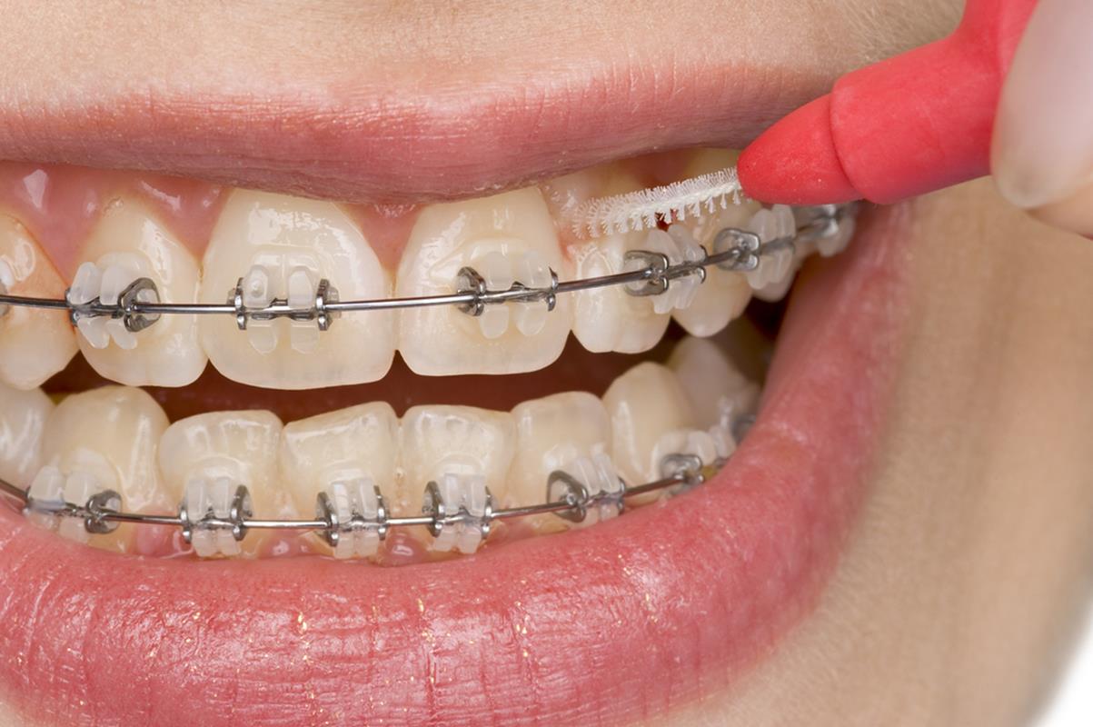 Types of Braces in Goddard, Hutchinson & Wichita Hansen Orthodontics